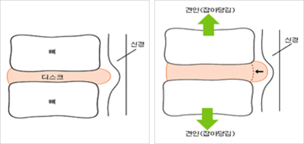 Cox 테크닉 이미지