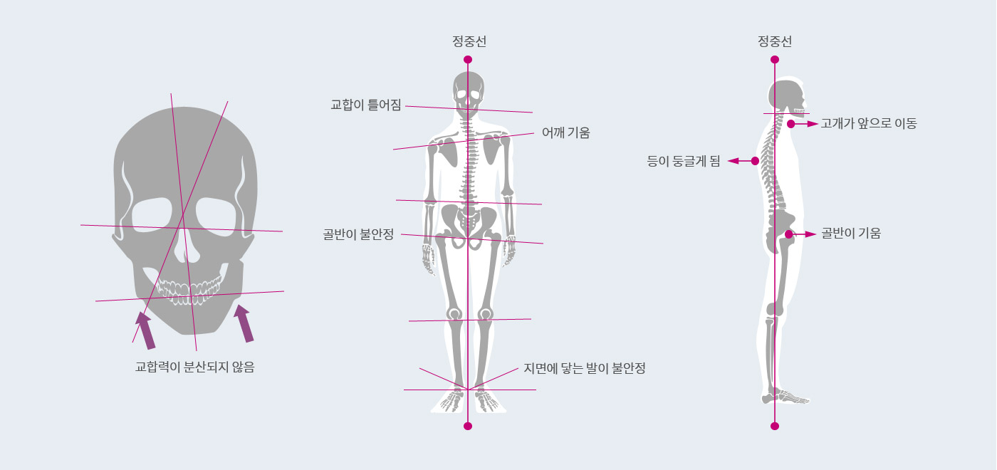 턱관절 장애 원인 이미지