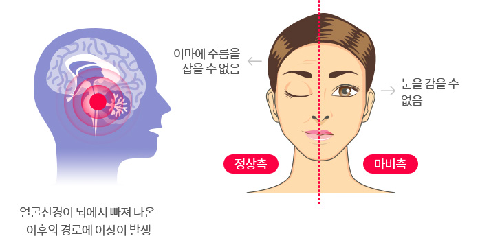 말초성 얼굴마비 이미지