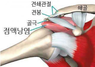 어깨 충졸 증후군 그림