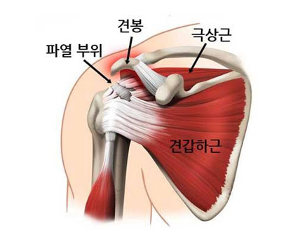 회전근개손상 이미지