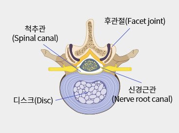 협착증 이미지1