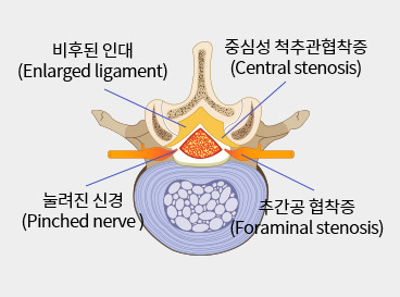 협착증 이미지2