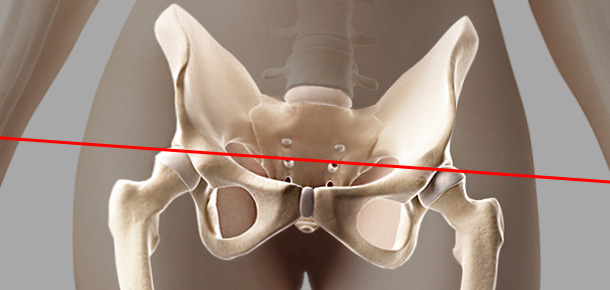 틀어진 골반 이미지